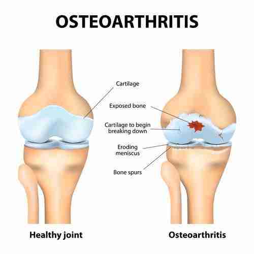 Knee Osteoarthritis symptoms, diagnosis and treatments