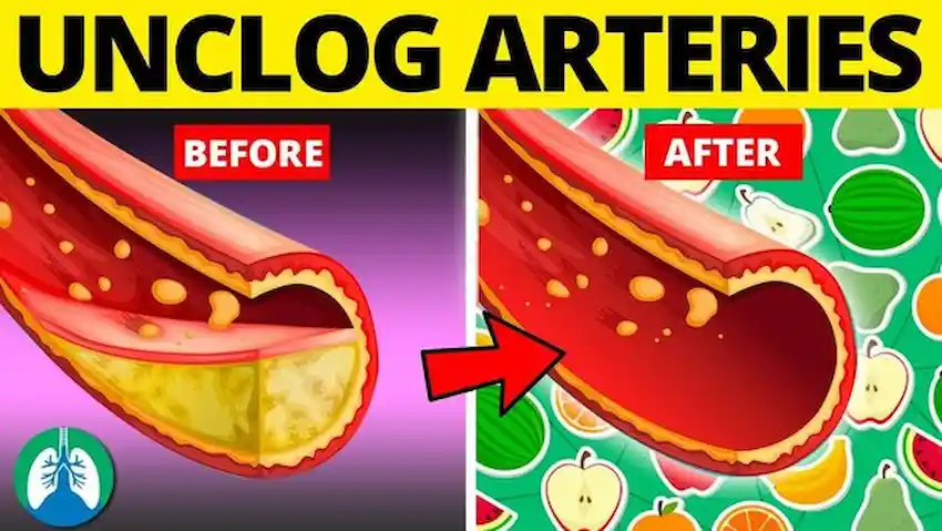 how to reduce plaque in arteries naturally