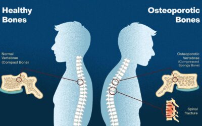 Silent Risk Factors Of Osteoporosis
