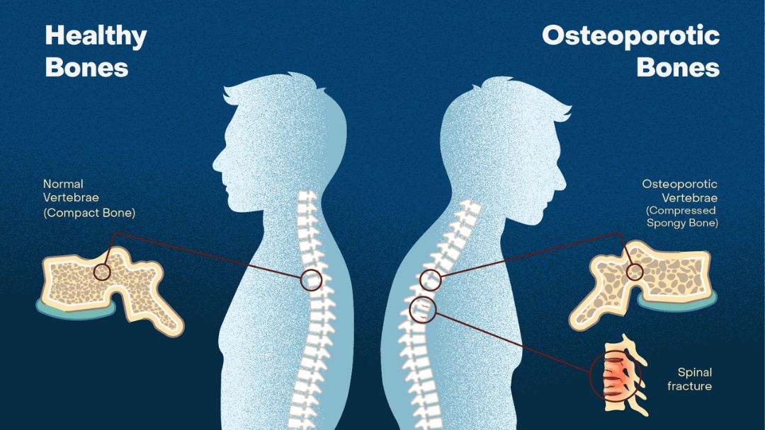 Silent Risk Factors Of Osteoporosis